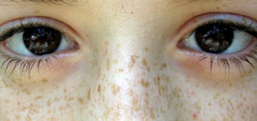 freckles