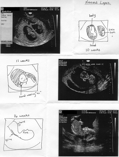 baby sonogram